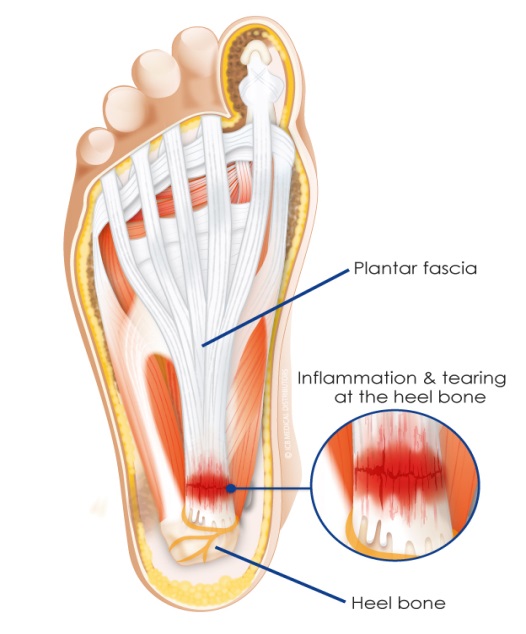 GUIDE-TO-PLANTAR-FASCIITIS